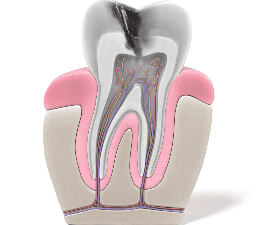 non-surgical root canal Charlotte