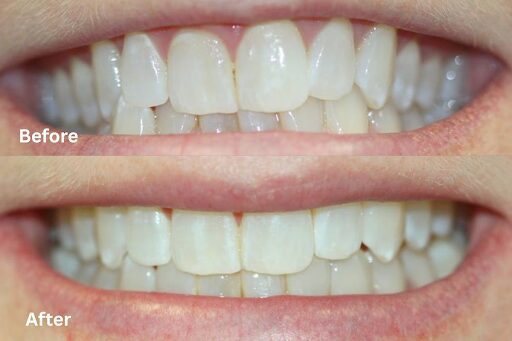 Before & After Invisalign Gallery