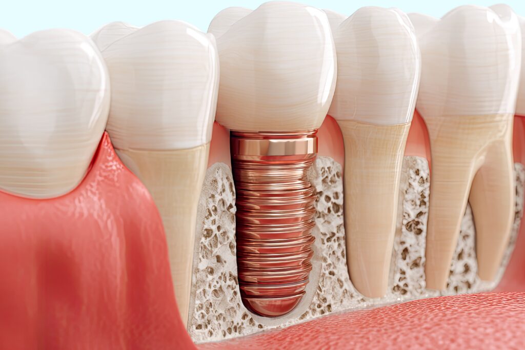 Missing Teeth Or Loose Dentures? Get Permanent Dental Implants In Blakeney, NC